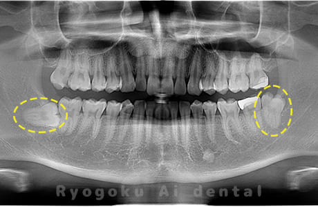 下顎左右の親知らず