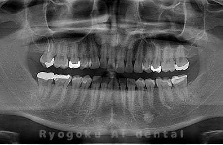 下顎左右の親知らずの親知らずを抜歯