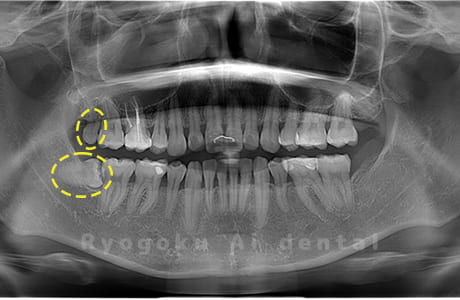 上下顎右の親知らず