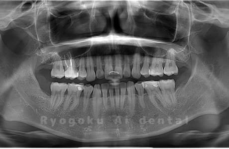 上下顎右の親知らずを抜歯