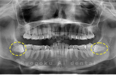下顎左右の親知らず