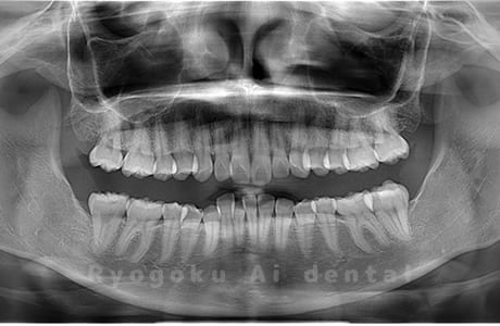 下顎左右の親知らずを抜歯