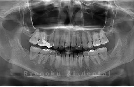 上下顎左右の親知らずを抜歯