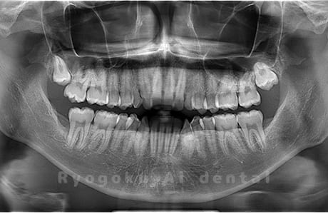 下顎左右の親知らずを抜歯