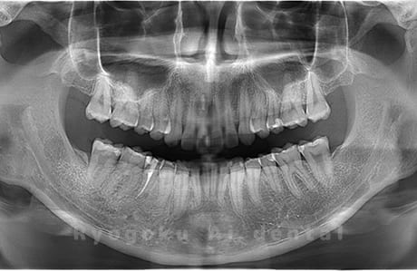 上顎左右、下顎右の親知らずを抜歯