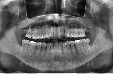 下顎左右の親知らずを抜歯