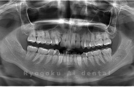 上顎右、下顎左右の親知らずを抜歯