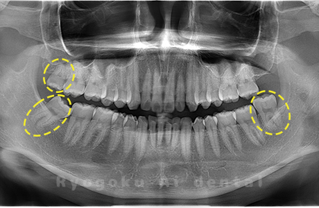 上顎右、下顎左右の親知らず
