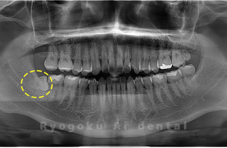 下顎右の親知らず