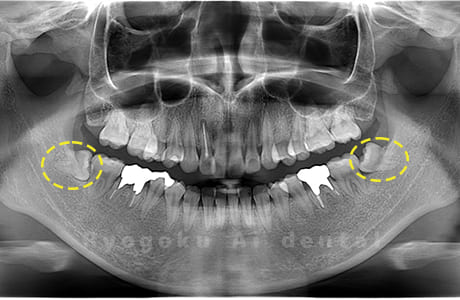 下顎左右の親知らず