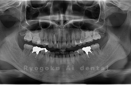 下顎左右の親知らずを抜歯