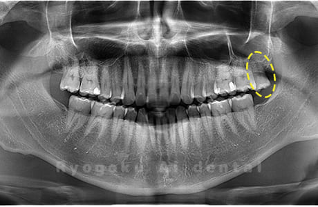 上顎左の親知らず