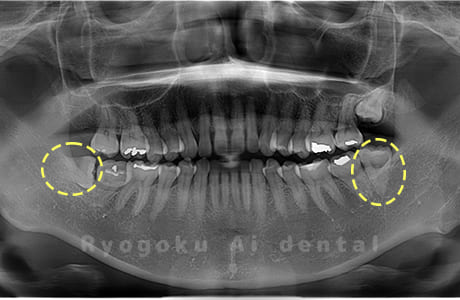 下顎左右の親知らず