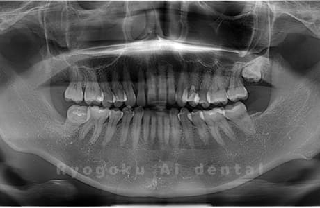 下顎左右の親知らずを抜歯