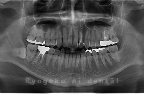 下顎左の親知らずを抜歯
