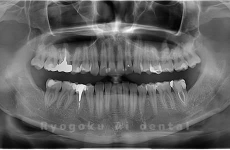 下顎左右の親知らずを抜歯