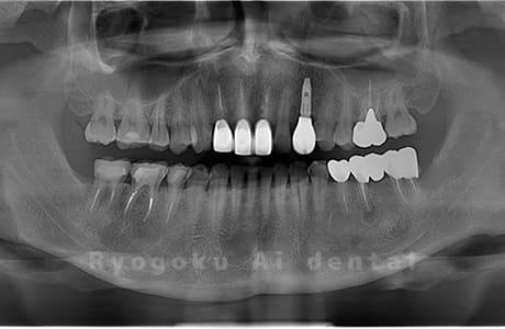 下顎左の親知らずを抜歯