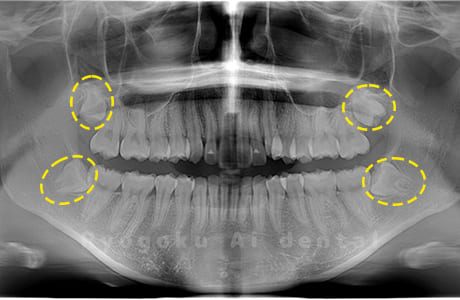 上下顎左右の親知らず