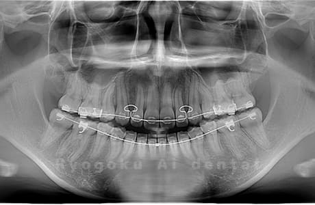 上下顎左右の親知らずを抜歯