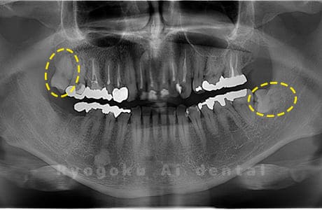 上顎右、下顎左の親知らず