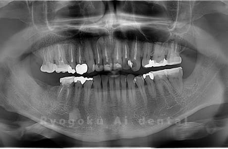上顎右、下顎左の親知らずを抜歯