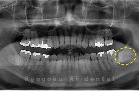 下顎左の親知らず
