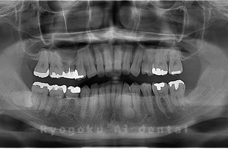 下顎左の親知らずを抜歯
