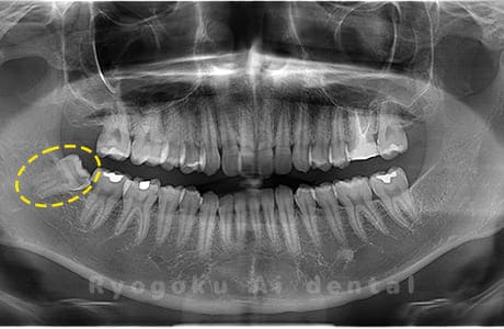 下顎右の親知らず