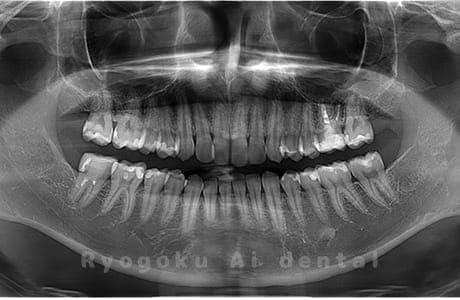 下顎右の親知らずを抜歯
